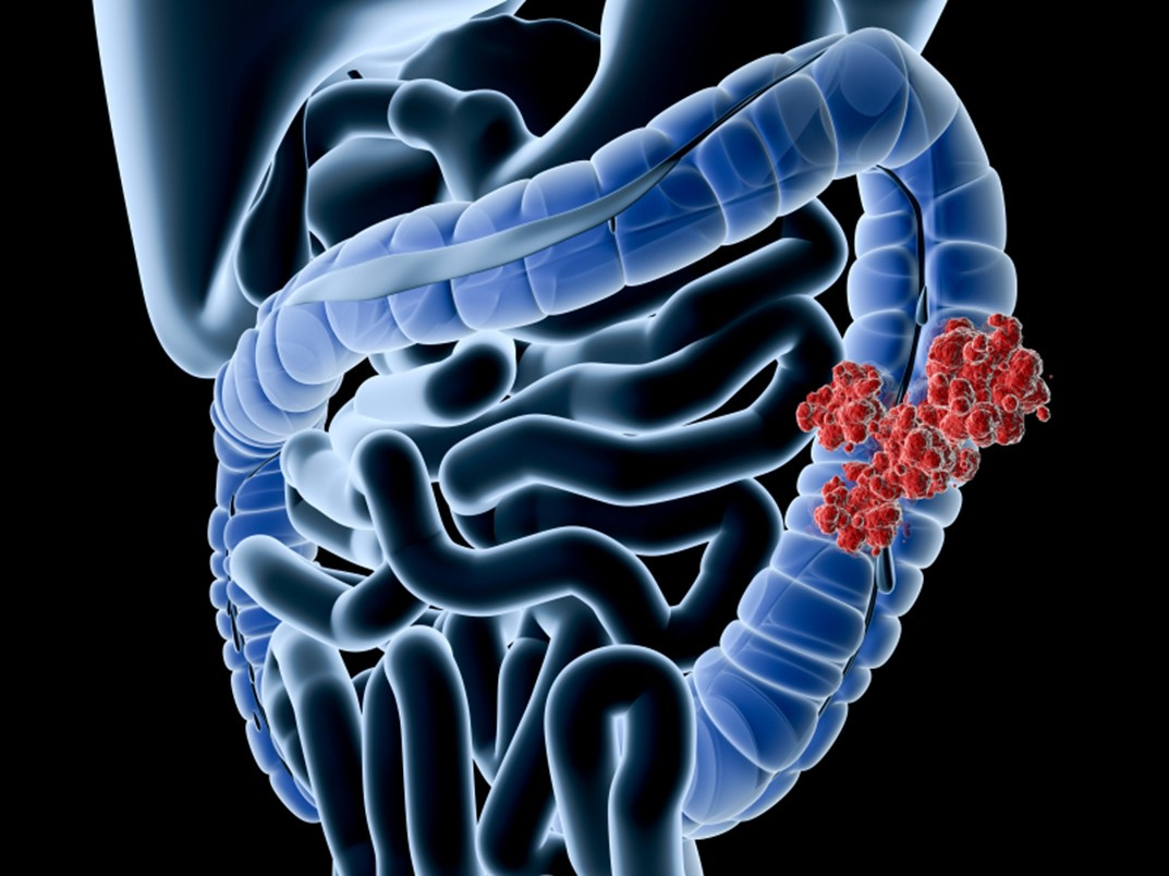 Rakovina hrubého čreva | Prevencia a liečba detoxikáciou